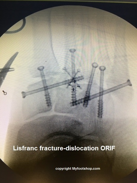 Lisfranc fracture ORIF